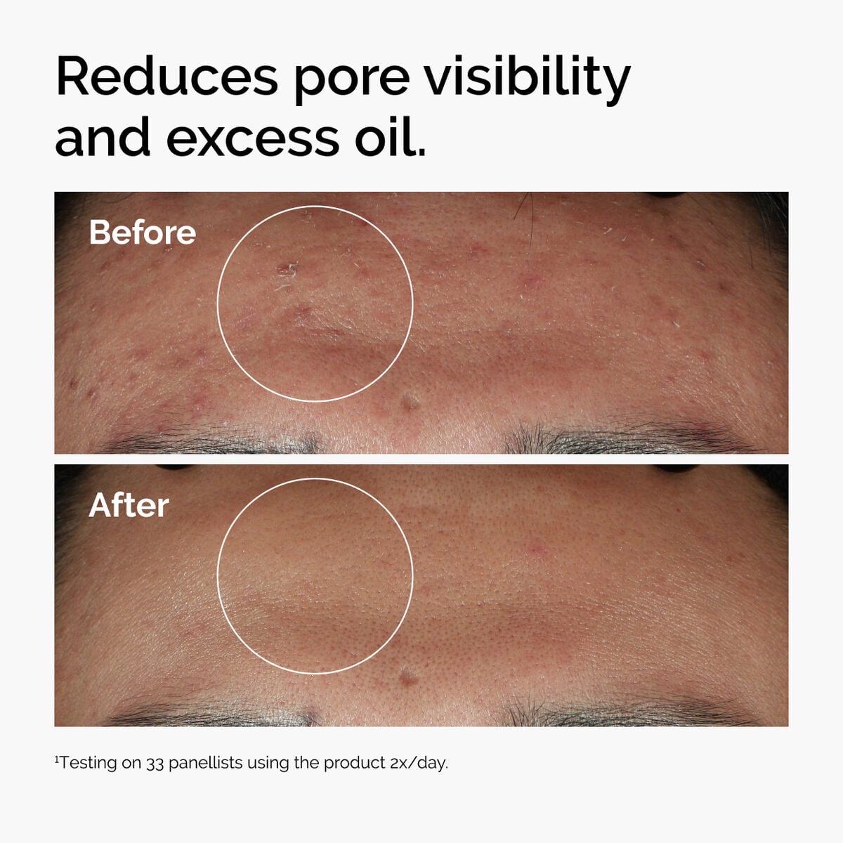 niacinamide-10-zinc-1-w0 ord-niacinamide-zinc-blemish-serum-before-after-pores.jpg
