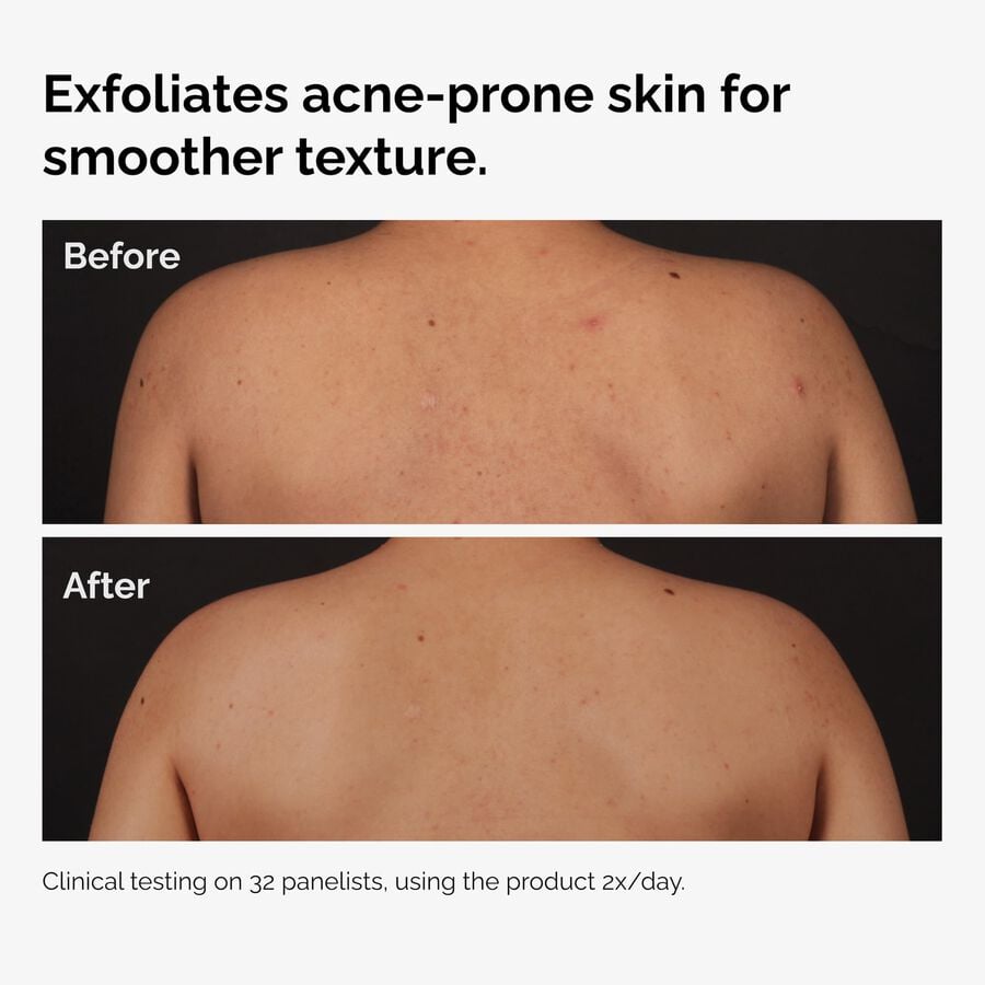 the-body-care-collection-q2 ord-salicylic-acid-body-serum-before-after-graphic-NA.jpg