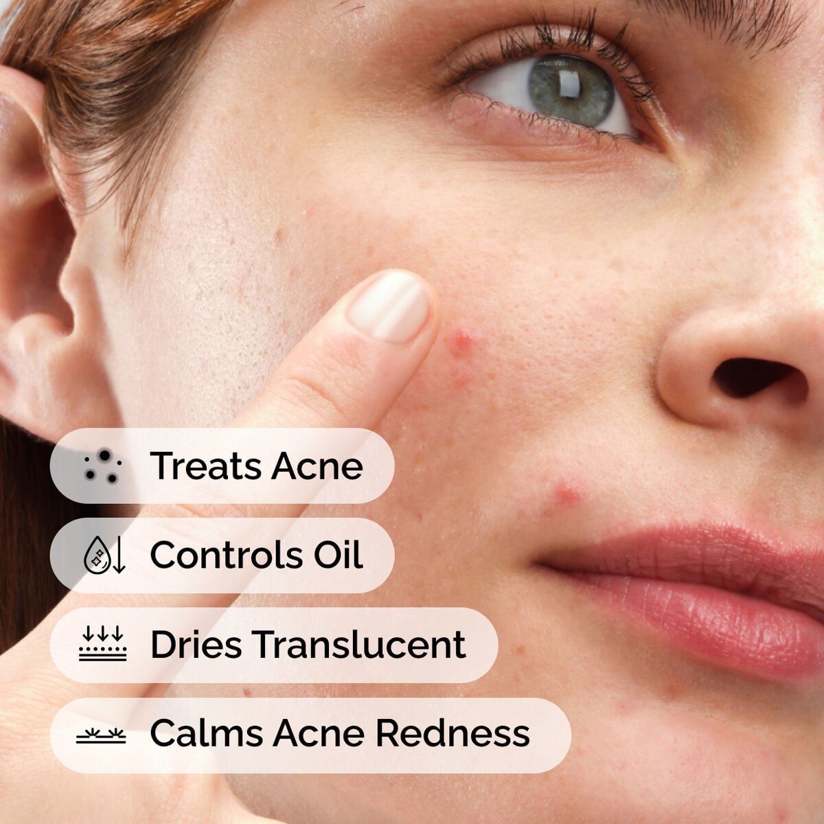 sulfur-10-powder-to-cream-concentrate-q4 ord-sulfur-10pct-powder-to-cream-concentrate-model-application-with-benefits-acne.jpg