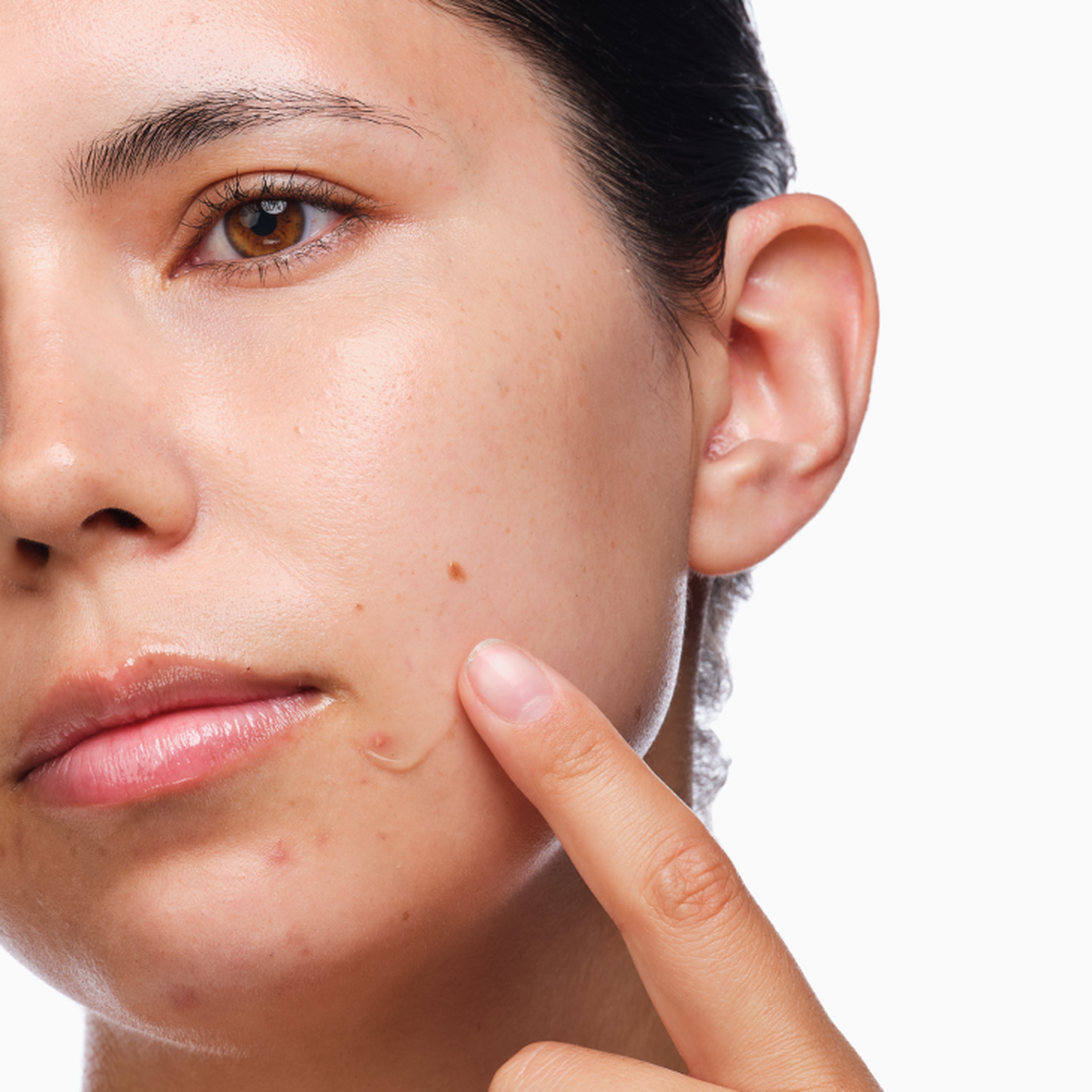 the-acne-set-v7 rdn-the-acne-set-application.png